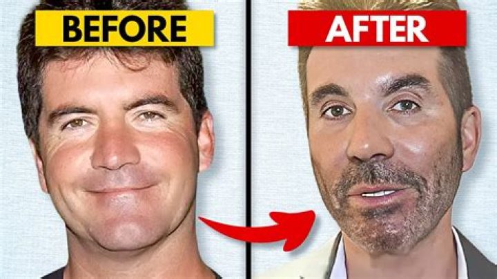 Simon Cowell Illness And Health Update: Before And After Surgery